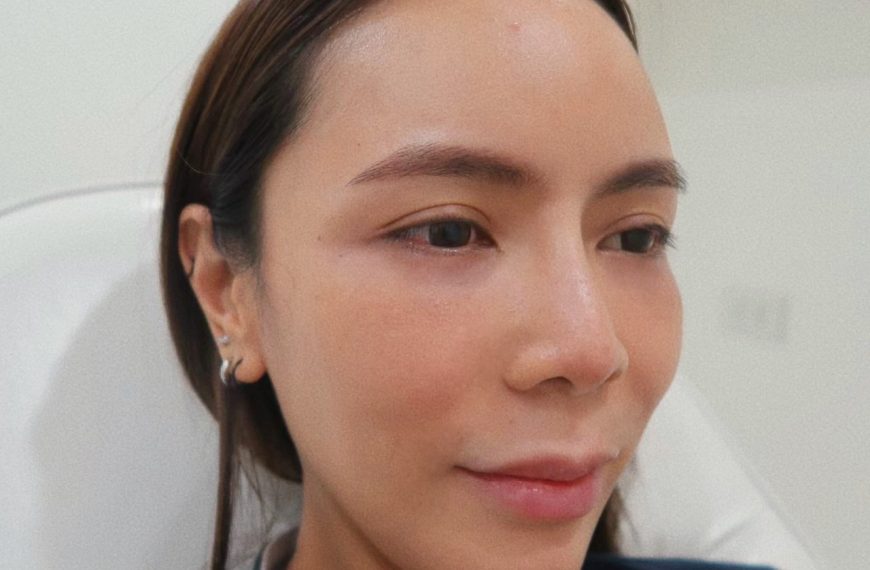 โบท็อกซ์ลดปีกจมูก (Reduces Nose Botox)